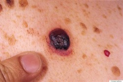 melanoma nodular