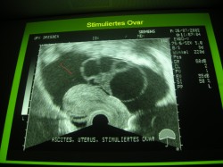 Ovario hiperestimulado con líquido ascíttico