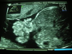 Oonfalocele fetal en ecografía 1