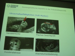Imágenes ecográficas predictivas de alteraciones cromosómicas fetales.
