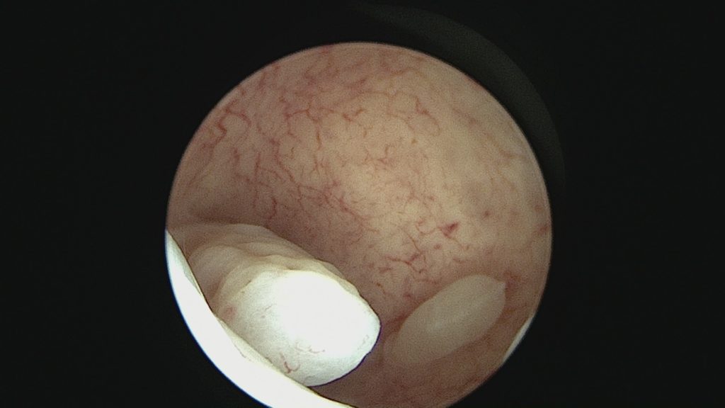 Imagen captada  por Histeroscopia en nuestro quirófano de pólipo endometrial que posteriormente fué reseccionado. Un saludo!